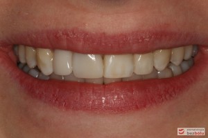 Uśmiech pacjentki po zakończonym leczeniu Uśmiech pacjentki po zakończonym leczeniu