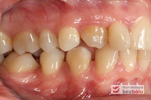 Wyprowadzony kieł ze zgryzu krzyżowego w niepełnym jeszcze wyrznięciu Wyprowadzony kieł ze zgryzu krzyżowego w niepełnym jeszcze wyrznięciu