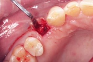 Odwarstwienie płata śluzówkowo-okostnowego