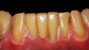 Gotowa praca ostateczna w odcinku przednim w żuchwie.