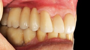 Widok pracy protetycznej od powierzchni policzkowy (widok z boku)