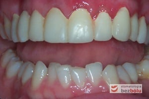 Tymczasowa odbudowa protetyczna wykonana celem ochrony filarów protetycznych i oceny estetycznej