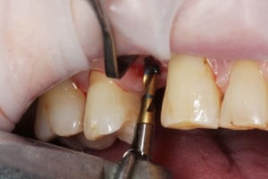 Preparacja łoża implantu