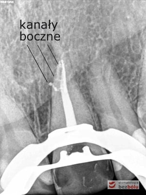 Kontrolne zdjęcie radiologiczne ujawniające kanały boczne Kontrolne zdjęcie radiologiczne ujawniające kanały boczne