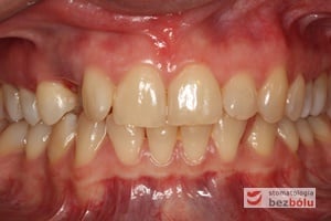 Łuk zębowy górny i dolny w zwarciu - widoczna luka po usuniętym mleczaku Łuk zębowy górny i dolny w zwarciu - widoczna luka po usuniętym mleczaku