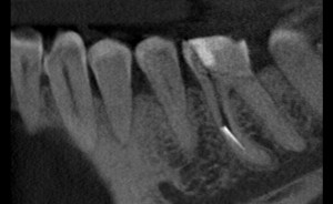 Screen z tomografii wolumetrycznej uwidoczniający kanał korzeniowy wraz z tkwiącym w nim narzędziem endodontycznym (biały kolor) - 3D_capture_small