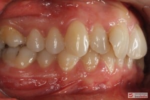 Warunki zgryzowe przed leczeniem - strona prawa