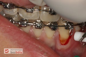 Krawienie z rowka dziąsłowego po przecięciu więzadła Krawienie z rowka dziąsłowego po przecięciu więzadła