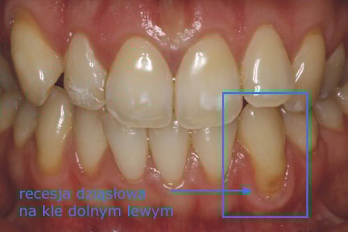 Zdjęcie przedstawiające recesję dziąsłową i odsłoniętą szyjkę zęba nr 33 Zdjęcie przedstawiające recesję dziąsłową i odsłoniętą szyjkę zęba nr 33 - recesje dziąsłowe