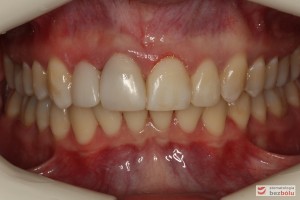 Warunki zgryzowe po zakończonym leczeniu Warunki zgryzowe po zakończonym leczeniu