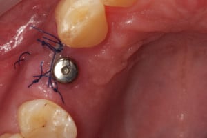 Zeszycie rany po ekspozycji implantu - widok od powierzchni okluzyjnej