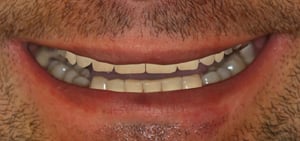 Zaakceptowany przez pacjenta projekt nowego uśmiechu Zaakceptowany przez pacjenta projekt nowego uśmiechu - DSD - Digital Smile Design