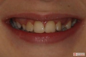 Uśmiech pacjenta przed leczeniem Uśmiech pacjenta przed leczeniem