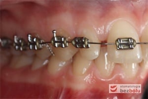 Aparat stały, faza niwelacyjna, łuk niklowo-tytanowy okrągły - strona prawa Aparat stały, faza niwelacyjna, łuk niklowo-tytanowy okrągły - strona prawa