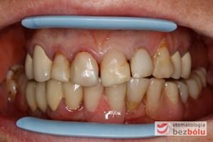 Zęby górne i dolne w zwarciu - pełne łuki - widoczny nieregularny kształt siekaczy górnych, przebarwienia i nawisające wypełnienia Zęby górne i dolne w zwarciu - pełne łuki - widoczny nieregularny kształt siekaczy górnych, przebarwienia i nawisające wypełnienia