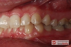 Widok warunków okluzyjnych przed leczeniem od strony lewej