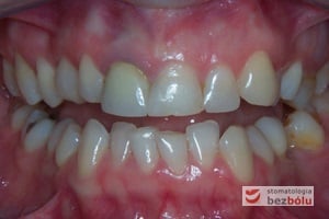 Stan wyjściowy w obu łukach zębowych - widoczne przesunięcie linii pośrodkowej w szczęce w stronę prawą