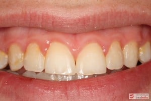 Uśmiech po leczeniu Uśmiech po leczeniu