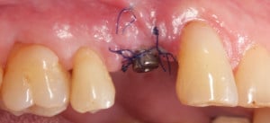 Zeszycie rany po ekspozycji implantu - widok od strony policzkowej