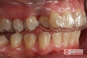 Pierwszy pozycjoner na zębach górnych - strona prawa Pierwszy pozycjoner na zębach górnych - strona prawa