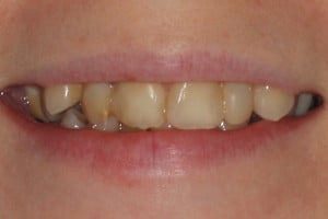 Uśmiech pacjentki przed leczeniem Uśmiech pacjentki przed leczeniem