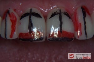 Oznaczanie koniecznych do przeprowadzenia modyfikacji - wyznaczenie osi długich zębów, zasięgu listewek brzeżnych i nadmiaru oraz niedomiaru ceramiki Oznaczanie koniecznych do przeprowadzenia modyfikacji - wyznaczenie osi długich zębów, zasięgu listewek brzeżnych i nadmiaru oraz niedomiaru ceramiki