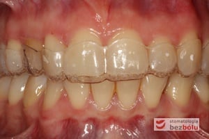 Łuk zębowy górny i dolny w zwarciu z założonym pozycjonerem Łuk zębowy górny i dolny w zwarciu z założonym pozycjonerem