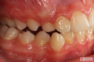 Warunki okluzyjne, strona prawa, przed leczeniem Warunki okluzyjne, strona prawa, przed leczeniem