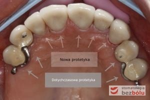 Nowa i dotychczasowa protetyka - porównanie Nowa i dotychczasowa protetyka - porównanie