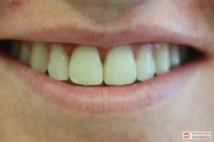 Uśmiech po leczeniu