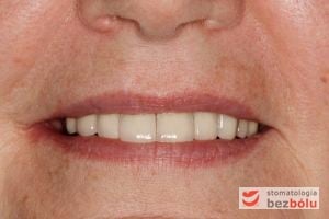 Ostateczny efekt estetyczny - okraszony uśmiechem pacjenta - bezcenne Ostateczny efekt estetyczny - okraszony uśmiechem pacjenta - bezcenne