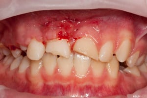 Złamany uśmiech dziecka (6 of 8)