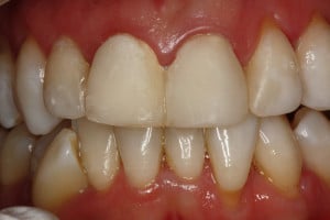 Temporaryzacja - umieszczenie prowizorium oraz wypełnień w siekaczach bocznych Temporaryzacja - umieszczenie prowizorium oraz wypełnień w siekaczach bocznych