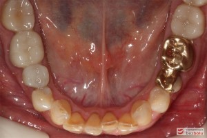 Pozostawiono złote onlay'e z uwagi na szczelność i bardzo dobrą kondycję - łuk dolny Pozostawiono złote onlay'e z uwagi na szczelność i bardzo dobrą kondycję - łuk dolny