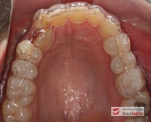 Pierwszy pozycjoner mający na celu przemieszczenie kła na stronę wargową Pierwszy pozycjoner mający na celu przemieszczenie kła na stronę wargową