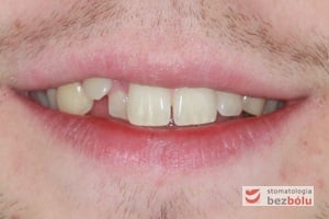 Uśmiech pacjenta przed leczeniem Uśmiech pacjenta przed leczeniem