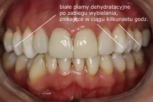 Efekt końcowy - radosny uśmiech powrócił ! Efekt końcowy - radosny uśmiech powrócił !