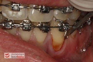 Zabieg chirurgiczny polegający na pokryciu recesji metodą dokoronowego przesunięcia płata Zabieg chirurgiczny polegający na pokryciu recesji metodą dokoronowego przesunięcia płata