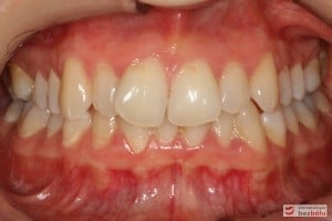 Warunki zgryzowe przed leczeniem