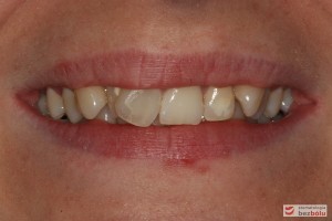 Uśmiech pacjentki przed leczeniem Uśmiech pacjentki przed leczeniem