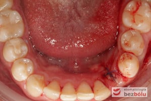 Wypreparowane łoża implantów