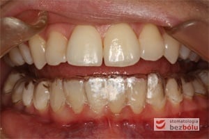 Gotowa nakładka prostująca zęby w jamie ustnej Gotowa nakładka prostująca zęby w jamie ustnej