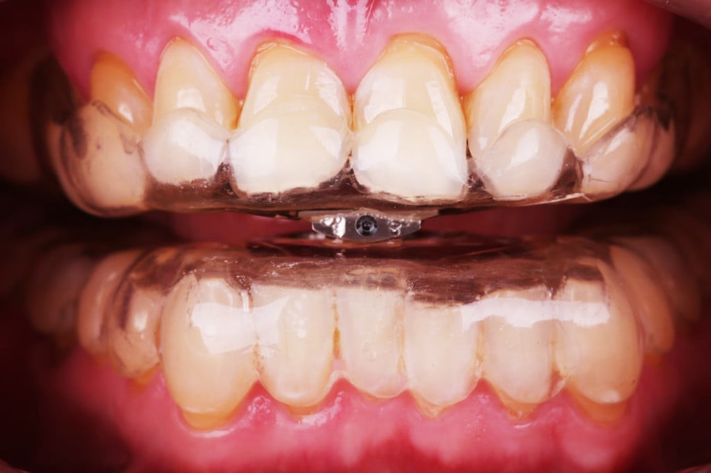 Pacjent Stomatologii Bez Bólu