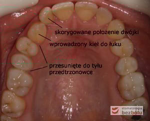 Stan po 5 miesiącach leczenia płytką Stan po 5 miesiącach leczenia płytką