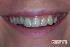 Pacjentka w wieku 35 lat - oczekiwanie poprawy estetyki górnego łuku zębowego wad zębowych