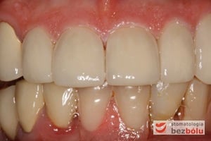 Ostateczna odbudowa protetyczna zębów przednich szczęki - pełnoceramiczne korony po korekcie osadzone na anatomicznych filarach protetycznych Ostateczna odbudowa protetyczna zębów przednich szczęki - pełnoceramiczne korony po korekcie osadzone na anatomicznych filarach protetycznych