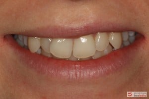 Uśmiech pacjentki przed leczeniem