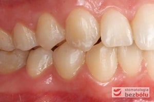 Warunki okluzyjne po leczeniu po stronie prawej