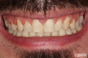 Uśmiech po leczeniu i wykonaniu wstępnej rekonstrukcji rudymentowanych siekaczy bocznych Uśmiech po leczeniu i wykonaniu wstępnej rekonstrukcji rudymentowanych siekaczy bocznych