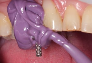 Pobieranie wycisku z transferem wyciskowym masą polieterową